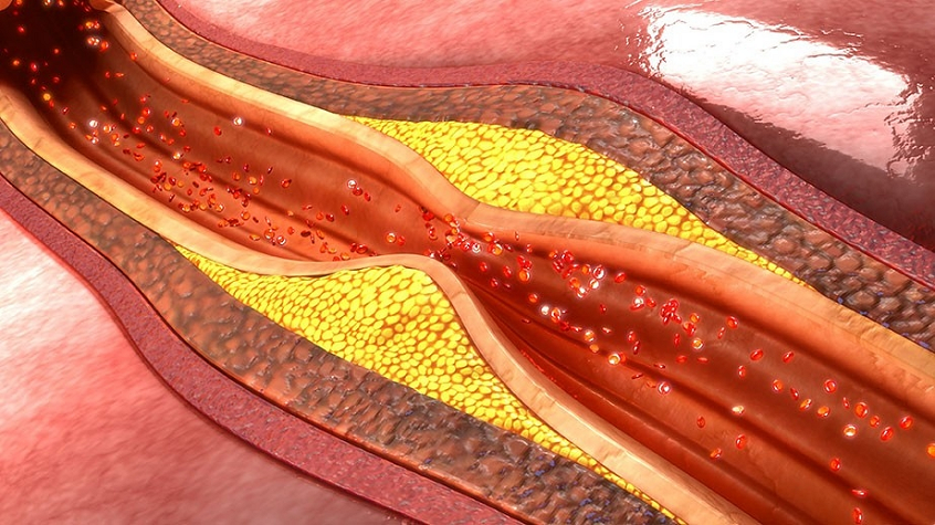 Peripheral Artery Disease